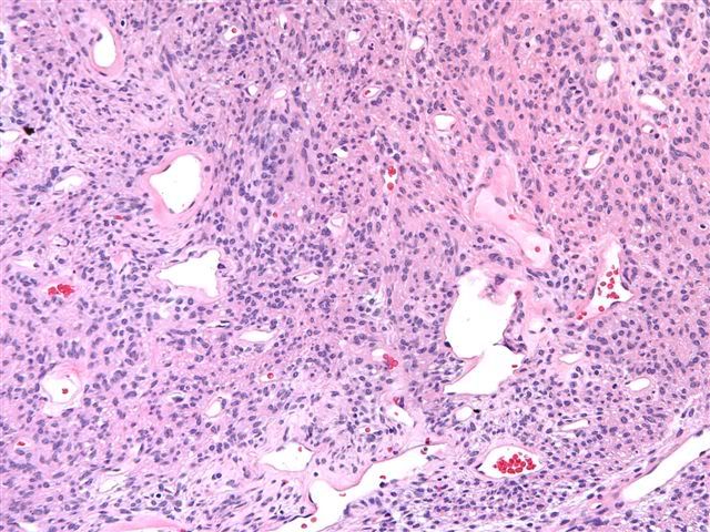 Hemangiopericytoma Photo by cat_at_uw Photobucket